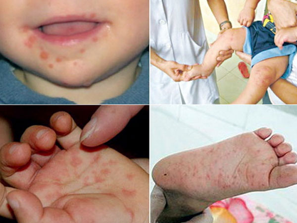 Sốt xuất huyết chưa qua, lo thêm tay chân miệng