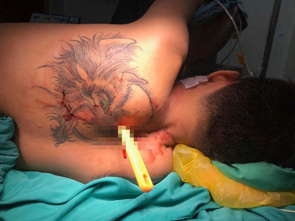 Cứu sống nam thanh niên bị bạn gái đâm thủng phổi
