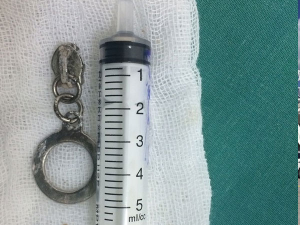 Bé 2 tuổi ăn vào là nôn vì khóa kéo sắt nằm trong thực quản