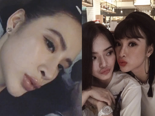 Lộ ảnh môi sưng vều, Angela Phương Trinh có thừa nhận dao kéo?
