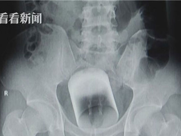Người đàn ông nhét cả chiếc cốc thủy tinh vào hậu môn