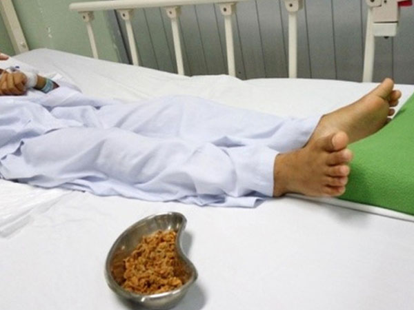 Con đau quặn bụng 4 ngày, mẹ tá hoả phát hiện hàng chục hạt sơ ri trong người bé trai 11 tuổi