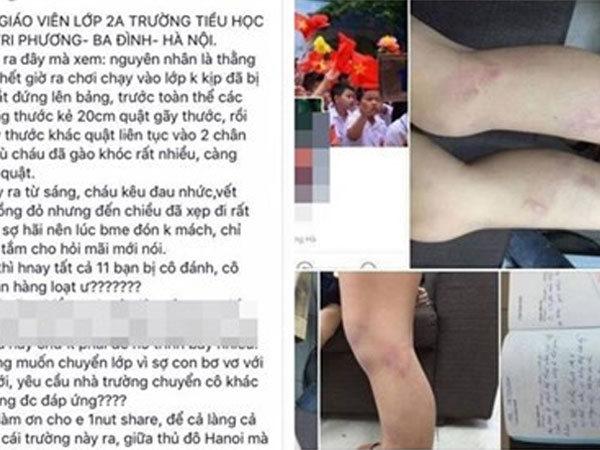 Cô giáo đánh học sinh bầm tím chân bị kỷ luật cảnh cáo