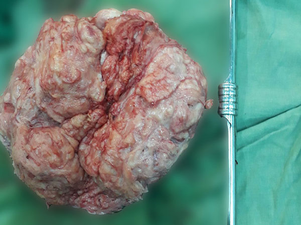 Người phụ nữ có bụng to như mang bầu, bác sĩ phẫu thuật mới phát hiện khối u khủng
