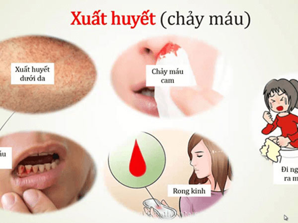 Sốt xuất huyết có lây qua đường tình dục không?