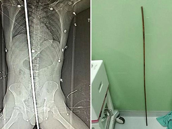 Công nhân xây dựng bị sét đánh, thanh thép dài 2m đâm xuyên người vẫn sống sót kỳ diệu
