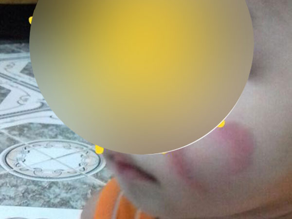 Hà Nam: Phụ huynh "tố" giáo viên mầm non bỏ lớp khiến các cháu cào nhau rách mặt