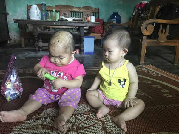 Kỳ lạ người phụ nữ 27 tuổi mang hình hài "trẻ lên 2" ở Thái Nguyên
