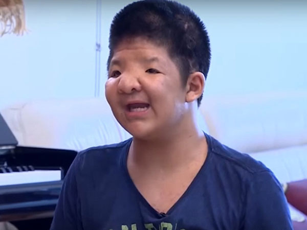 Nguyên giám đốc Bệnh viện Nhi Trung ương kể chuyện những ngày đầu chữa bệnh của bé Bôm