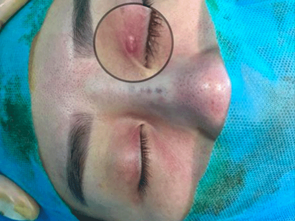 Hãi hùng với làm đẹp tại spa “chui”: “"Nhấn mí mắt, lúc khâu bị đứt chỉ nên để lại kim luôn trong mí mắt"