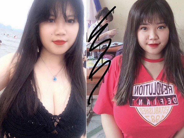 Nỗi khổ của cô gái Hải Dương mang vòng 1 hơn 110cm