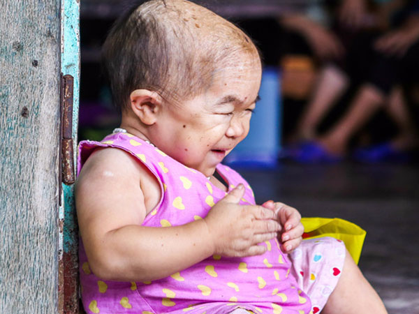 Cô gái gần 30 vẫn mang hình hài của đứa trẻ 2 tuổi: Lủi thủi trong nhà cả đời, không có bạn cùng chơi