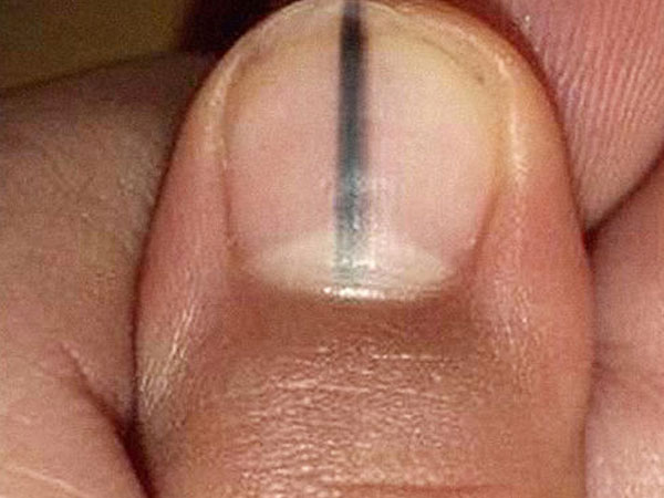Móng tay có sọc đen, đau đớn dấu hiệu u ác tính