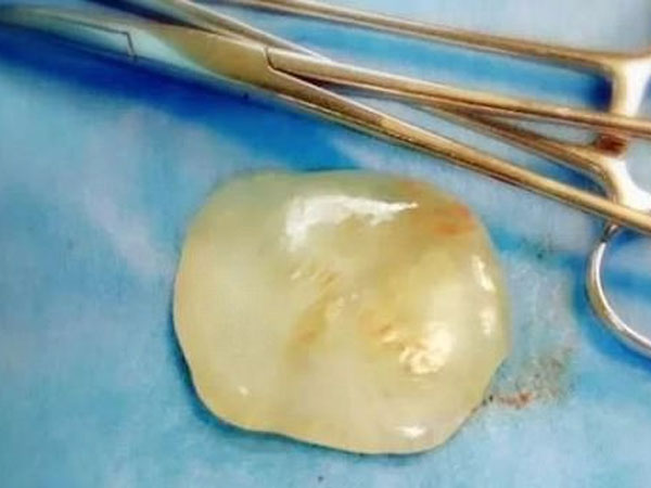 Mẹ đang sinh con, có viên "đá quý" trong bụng chui ra