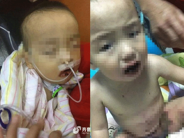 Tưởng nhầm chất tẩy là đường trắng, bé trai lấy ăn và nhập viện trong tình trạng nguy kịch