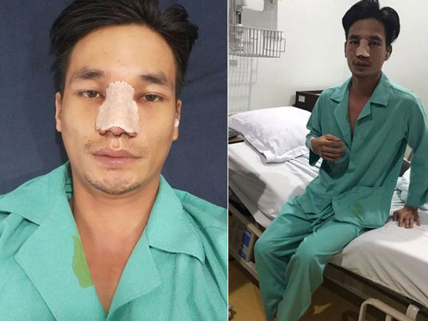Chán mũi nhân tạo, Lệ Rơi lại sửa để tìm về diện mạo ban đầu