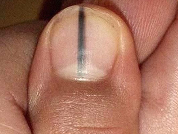 Câu chuyện kinh hãi này sẽ lý giải vì sao bạn không được bỏ qua một vết sọc đen trên móng tay