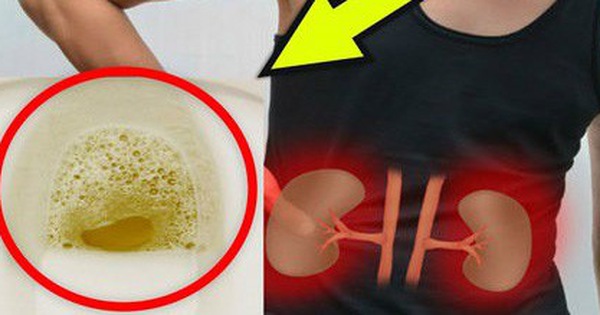 Cẩn thận với những triệu chứng kéo dài đang ngầm cảnh báo nguy cơ suy thận sắp xảy ra