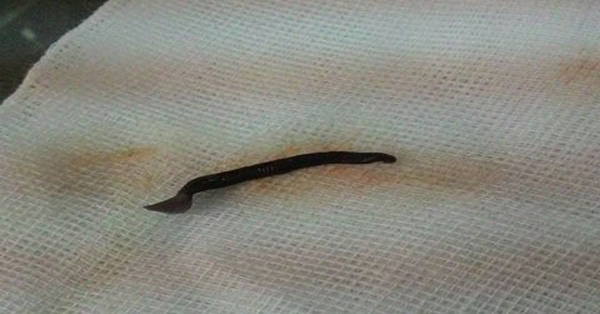 Kinh hãi: Bé gái nhập viện do bị đỉa cắn sâu trong âm đạo