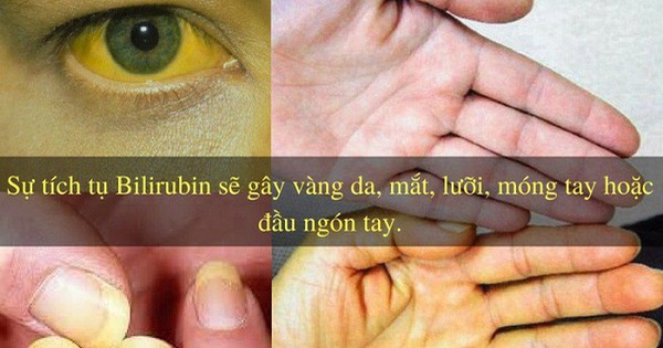 34 tuổi đã xơ gan giai đoạn cuối: Bác sĩ chỉ tận mặt thủ phạm gây ra 70% trường hợp xơ gan