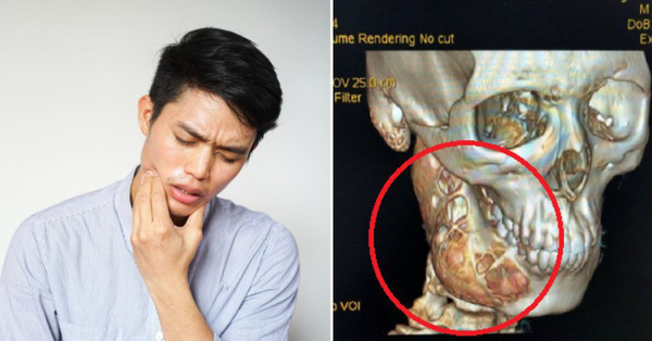 Đau răng 1 năm mới đi khám, cậu bé 15 tuổi khiến bác sĩ sốc khi bị 'ăn mòn' 1 nửa xương hàm phải do ung thư