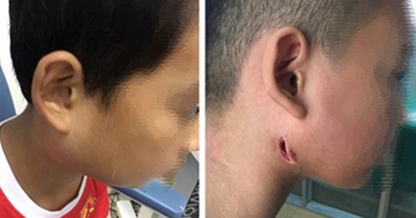 Một bệnh viện ở Nghệ An công bố 3 trẻ nhiễm bệnh Whitmore 'ăn thịt người': Cảnh báo dấu hiệu dễ nhầm lẫn với bệnh quai bị